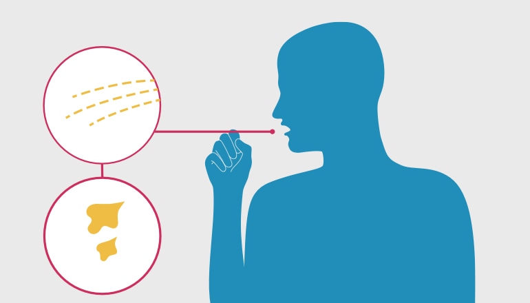 Illustration showing a man coughing up mucous, which is a symptom of acute bronchitis